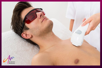  laser hair removal for men